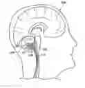 Fig. 01 - Method of stimulating fastigium nucleus to treat neurological disorders