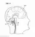Fig. 03 - Method of stimulating fastigium nucleus to treat neurological disorders