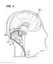 Fig. 04 - Method of stimulating fastigium nucleus to treat neurological disorders