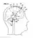 Fig. 06 - Method of stimulating fastigium nucleus to treat neurological disorders