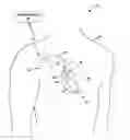 Fig. 01 - Supraventricular stimulation to control ventricular rate