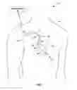Fig. 02 - Supraventricular stimulation to control ventricular rate