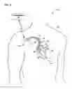 Fig. 02 - Cardiac therapy based upon impedance signals