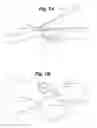 Fig. 07 - Implant tool and improved electrode design for minimally invasive procedure
