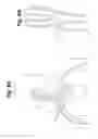 Fig. 08 - Implant tool and improved electrode design for minimally invasive procedure