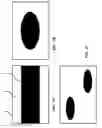 Fig. 03 - STENT WITH RADIALLY ASYMMETRIC FORCE DISTRIBUTION
