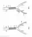 Fig. 04 - Energized stents and methods of using the same