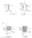 Fig. 03 - Artificial valve prosthesis with a free leaflet portion
