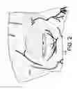 Fig. 03 - INFRA-ORBITAL IMPLANT