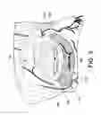 Fig. 04 - INFRA-ORBITAL IMPLANT