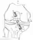 Fig. 01 - System and method for ligament reconstruction