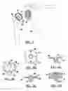 Fig. 02 - Modular humeral head resurfacing system