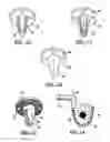 Fig. 04 - Modular humeral head resurfacing system