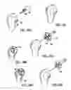 Fig. 09 - Modular humeral head resurfacing system
