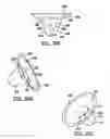 Fig. 11 - Modular humeral head resurfacing system