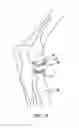 Fig. 07 - Modular prosthesis and use thereof for replacing a radial head