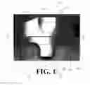 Fig. 03 - Low stress all poly tibial component