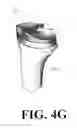 Fig. 13 - Low stress all poly tibial component