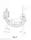 Fig. 06 - Tibial component of a knee prosthesis having an angled cement pocket