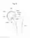 Fig. 29 - Hip joint device