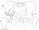 Fig. 01 - Acetabular Cartilage Implant