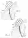Fig. 06 - Acetabular Cartilage Implant