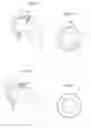 Fig. 44 - Medical device and a method for treating a hip joint