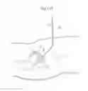 Fig. 55 - Medical device and a method for treating a hip joint