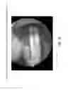 Fig. 29 - Method and apparatus for restoring articular cartilage