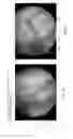Fig. 30 - Method and apparatus for restoring articular cartilage