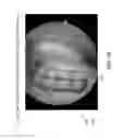 Fig. 31 - Method and apparatus for restoring articular cartilage