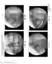Fig. 33 - Method and apparatus for restoring articular cartilage