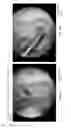 Fig. 34 - Method and apparatus for restoring articular cartilage