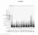 Fig. 07 - Gene expression profiles to predict relapse of prostate cancer