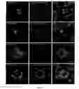 Fig. 03 - Method for Diagnosing or Predicting a Non Syndromic Autosomal Recessive Optic Atrophy, or a Risk of a Non Syndromic Autosomal Recessive Optic Atrophy