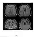 Fig. 10 - Method for Diagnosing or Predicting a Non Syndromic Autosomal Recessive Optic Atrophy, or a Risk of a Non Syndromic Autosomal Recessive Optic Atrophy