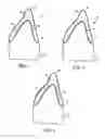 Fig. 02 - Integrated Porcelain System for a Dental Prosthesis