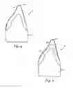 Fig. 03 - Integrated Porcelain System for a Dental Prosthesis