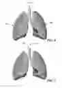 Fig. 04 - Device and method for assisting a cough