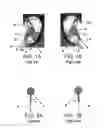 Fig. 02 - USING ACCELEROMETERS FOR LEFT RIGHT DETECTION OF HEADSET EARPIECES