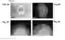 Fig. 06 - EMBRYONIC STEM CELLS AND NEURAL PROGENITOR CELLS DERIVED THEREFROM