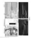 Fig. 07 - Use of liposomal Wnt composition to enhance osseointegration