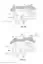 Fig. 08 - APPARATUS AND METHOD FOR INTRA-ABDOMINALLY MOVING A FIRST INTERNAL ORGAN TO A POSITION AWAY FROM A SECOND INTERNAL ORGAN AND THEN HOLDING THE FIRST INTERNAL ORGAN IN THE POSITION WITHOUT MANUAL INPUT