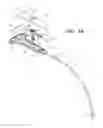 Fig. 04 - Self-anchoring sling and introducer system