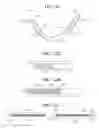 Fig. 31 - Self-anchoring sling and introducer system