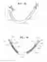 Fig. 34 - Self-anchoring sling and introducer system
