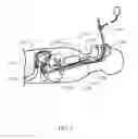 Fig. 06 - Optically guided medical tube and control unit assembly and methods of use