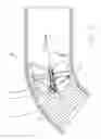Fig. 04 - IMAGING GUIDEWIRE