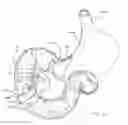 Fig. 02 - DEVICES FOR TREATING OBESITY AND METHODS OF USING THOSE DEVICES