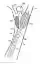 Fig. 01 - Balloon assisted occlusion of aneurysms
